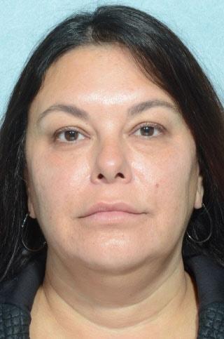 Deep Plane Facelift before at Chegar Facial Plastic Surgery in Carmel, IN