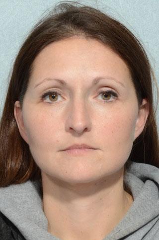 Brow Lift after at Chegar Facial Plastic Surgery in Carmel, IN