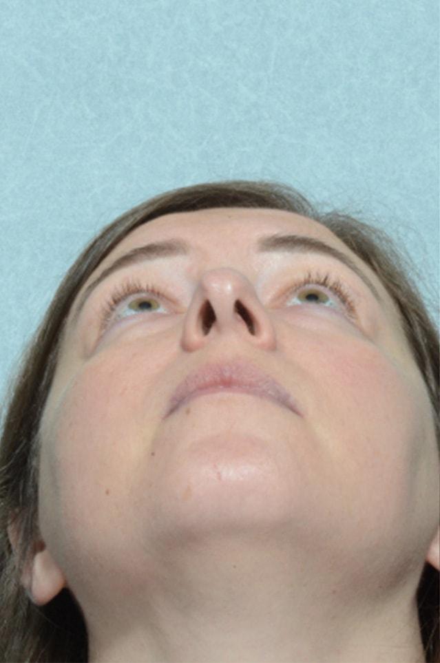 Rhinoplasty before at Chegar Facial Plastic Surgery in Carmel, IN
