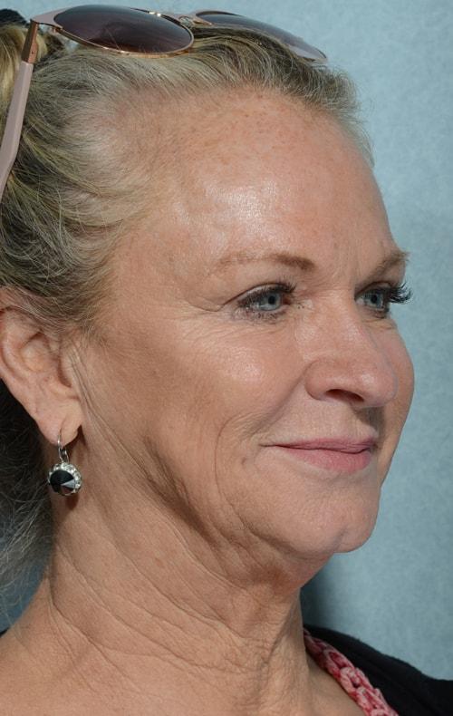 Fat Transfer before at Chegar Facial Plastic Surgery in Carmel, IN