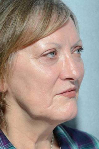 Fat Transfer before at Chegar Facial Plastic Surgery in Carmel, IN