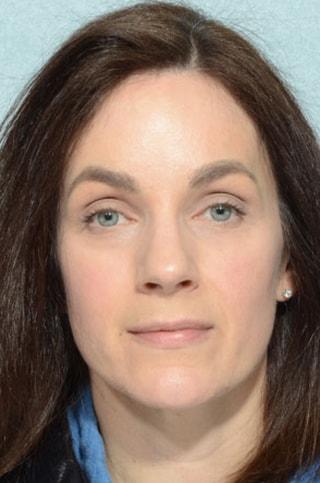 Chegar Facial Plastic Surgery eyelid lift after — Carmel, IN