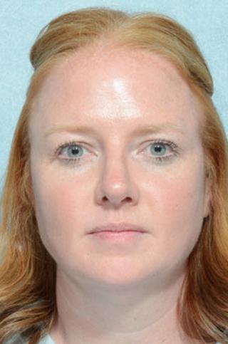 Rhinoplasty after at Chegar Facial Plastic Surgery in Carmel, IN