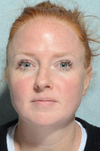 Rhinoplasty before at Chegar Facial Plastic Surgery in Carmel, IN