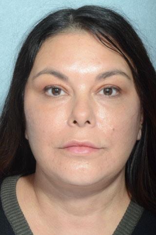 Deep Plane Facelift after at Chegar Facial Plastic Surgery in Carmel, IN
