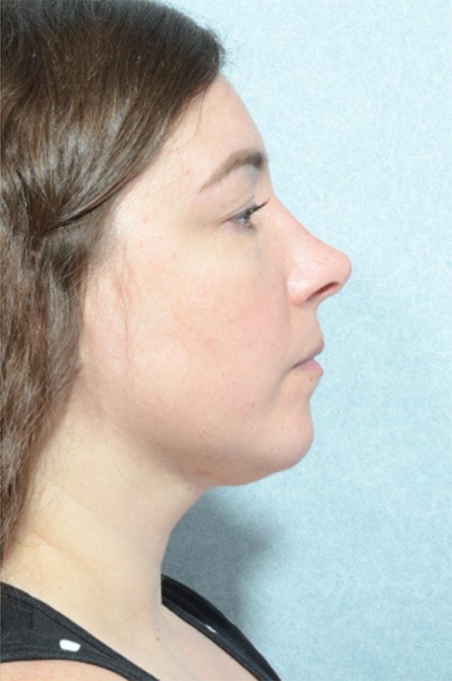 Rhinoplasty after at Chegar Facial Plastic Surgery in Carmel, IN