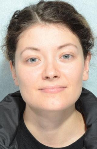 Chegar Facial Plastic Surgery ear pinning after — Carmel, IN