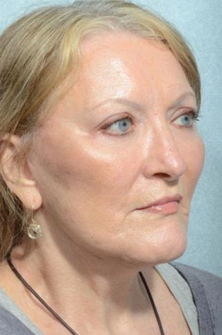 Chegar Facial Plastic Surgery fat transfer after — Carmel, IN