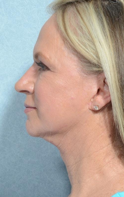 Fat Transfer after at Chegar Facial Plastic Surgery in Carmel, IN