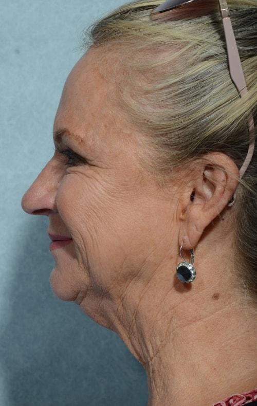 Fat Transfer before at Chegar Facial Plastic Surgery in Carmel, IN