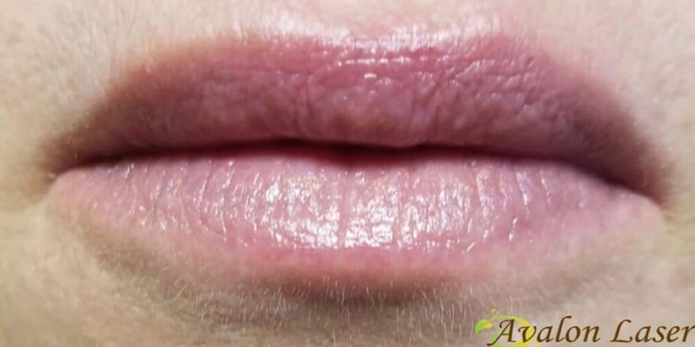 Avalon Laser | Carlsbad Botox Clinic and Medical Spa lip filler after — Carlsbad, CA