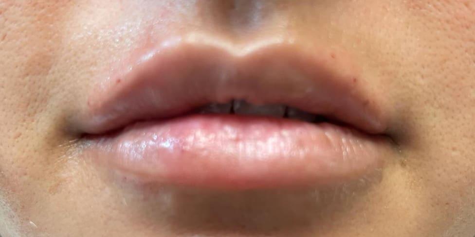 Avalon Laser | Carlsbad Botox Clinic and Medical Spa lip filler after — Carlsbad, CA