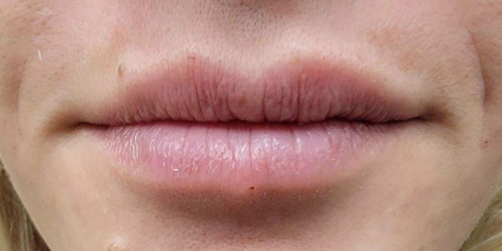 Avalon Laser | Carlsbad Botox Clinic and Medical Spa lip filler after — Carlsbad, CA