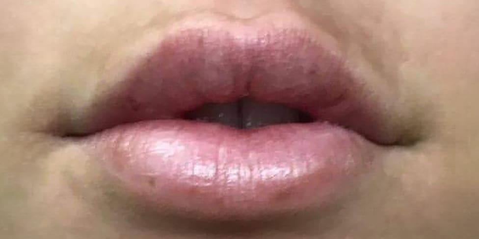 Avalon Laser | Carlsbad Botox Clinic and Medical Spa lip filler after — Carlsbad, CA