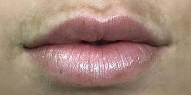 Lip Filler before at Avalon Laser | Carlsbad Botox Clinic and Medical Spa in Carlsbad, CA