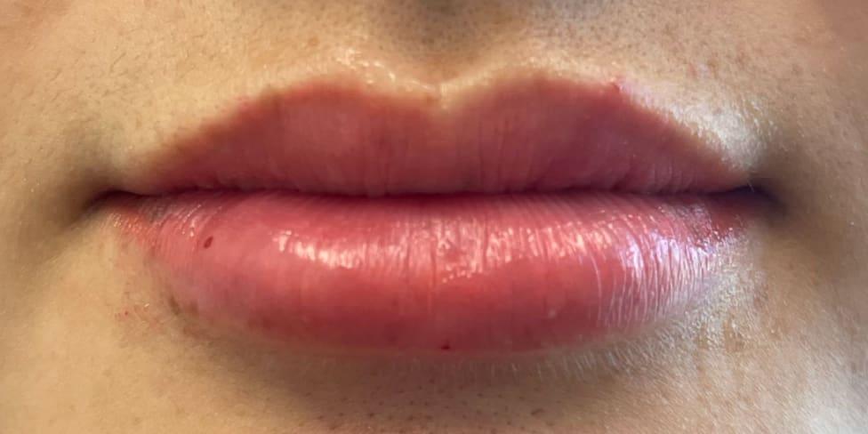 Avalon Laser | Carlsbad Botox Clinic and Medical Spa lip filler after — Carlsbad, CA