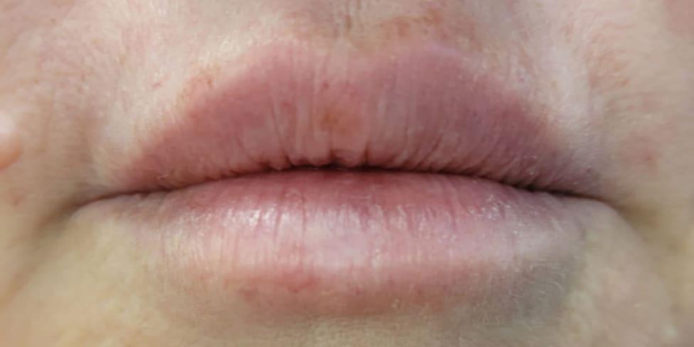 Avalon Laser | Carlsbad Botox Clinic and Medical Spa lip filler after — Carlsbad, CA