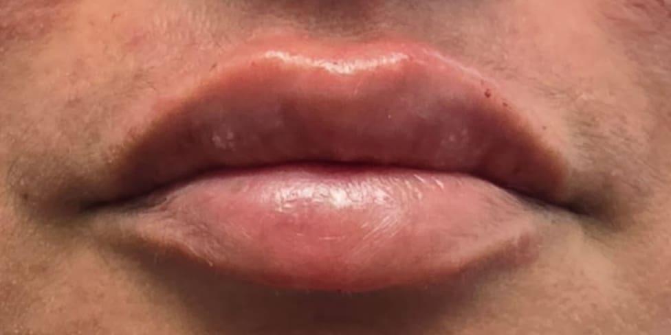 Avalon Laser | Carlsbad Botox Clinic and Medical Spa lip filler after — Carlsbad, CA