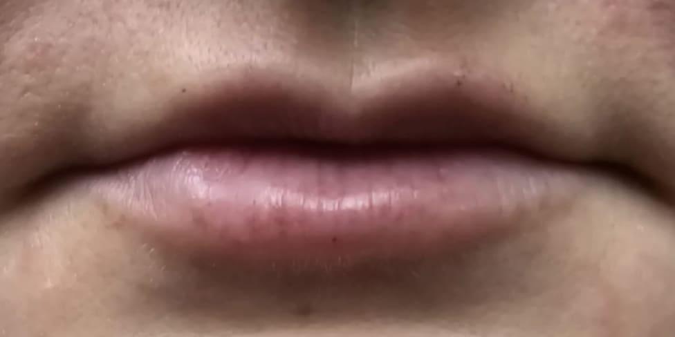 Avalon Laser | Carlsbad Botox Clinic and Medical Spa lip filler after — Carlsbad, CA