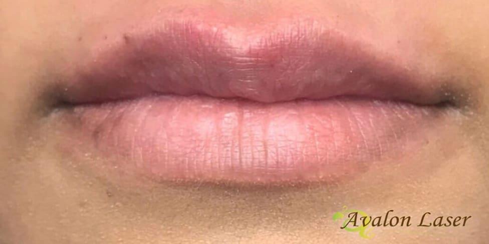 Avalon Laser | Carlsbad Botox Clinic and Medical Spa lip filler after — Carlsbad, CA