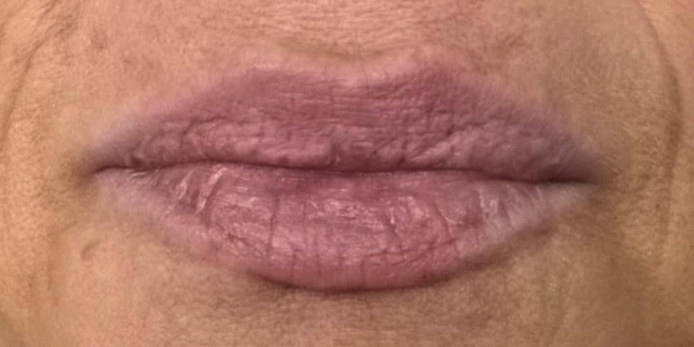 Avalon Laser | Carlsbad Botox Clinic and Medical Spa lip filler after — Carlsbad, CA