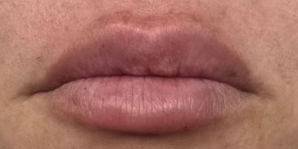 Avalon Laser | Carlsbad Botox Clinic and Medical Spa lip filler after — Carlsbad, CA