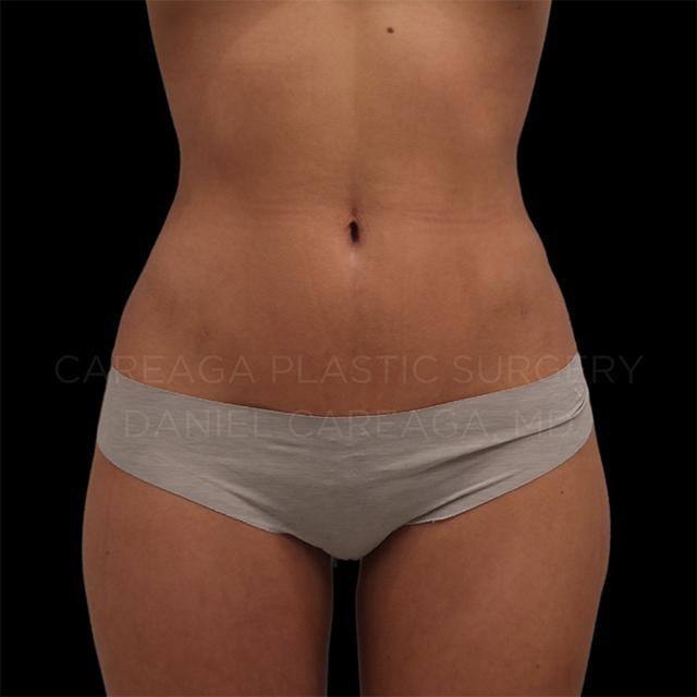 Liposuction after at Careaga Plastic Surgery in Coral Gables, FL