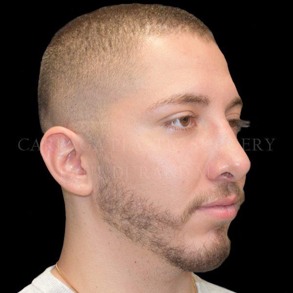 Rhinoplasty after at Careaga Plastic Surgery in Coral Gables, FL