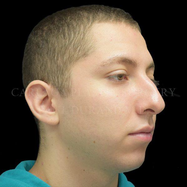 Rhinoplasty before at Careaga Plastic Surgery in Coral Gables, FL