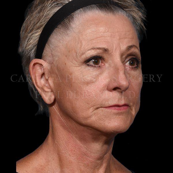Careaga Plastic Surgery facelift after — Miami, FL