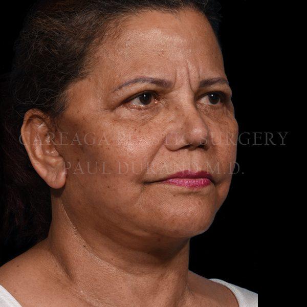 Careaga Plastic Surgery facelift after — Miami, FL