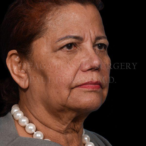 Facelift before at Careaga Plastic Surgery in Coral Gables, FL