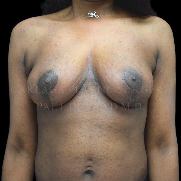 Breast Lift after at Careaga Plastic Surgery in Coral Gables, FL