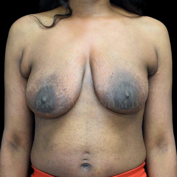 Breast Lift before at Careaga Plastic Surgery in Coral Gables, FL