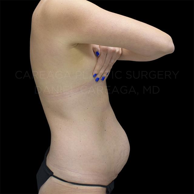 Mini Tummy Tuck before at Careaga Plastic Surgery in Coral Gables, FL