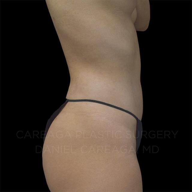 Liposuction after at Careaga Plastic Surgery in Coral Gables, FL