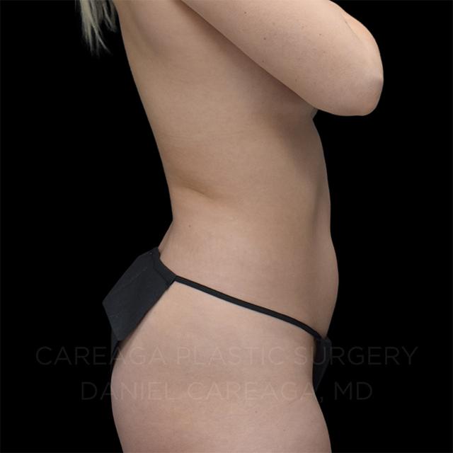 Liposuction before at Careaga Plastic Surgery in Coral Gables, FL