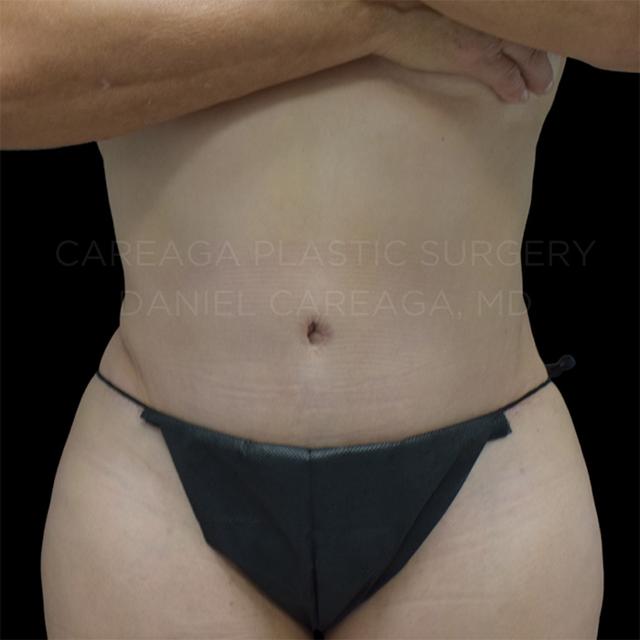 Mini Tummy Tuck after at Careaga Plastic Surgery in Coral Gables, FL