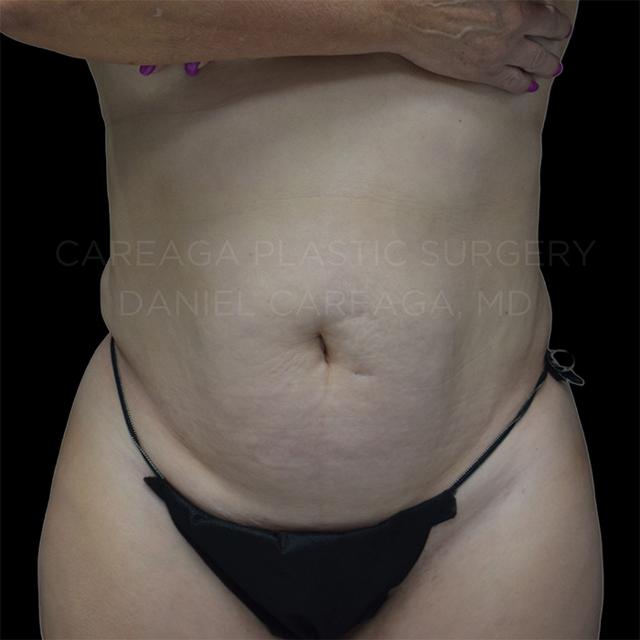 Mini Tummy Tuck before at Careaga Plastic Surgery in Coral Gables, FL