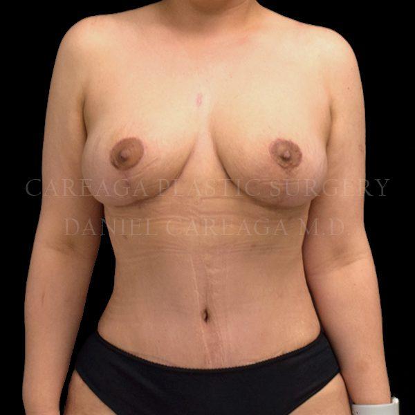 Mommy Makeover after at Careaga Plastic Surgery in Coral Gables, FL