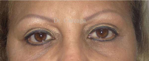 Careaga Plastic Surgery blepharoplasty after — Miami, FL