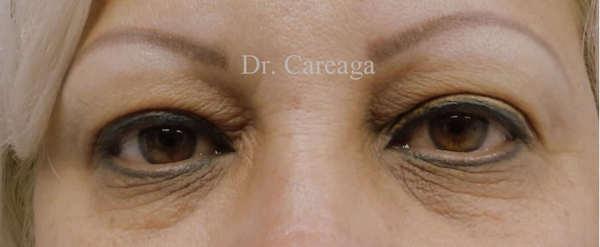 Blepharoplasty before at Careaga Plastic Surgery in Coral Gables, FL