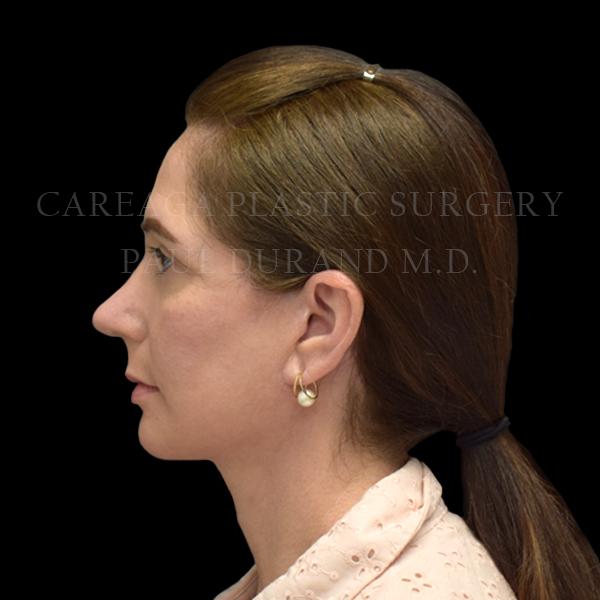 Rhinoplasty after at Careaga Plastic Surgery in Coral Gables, FL