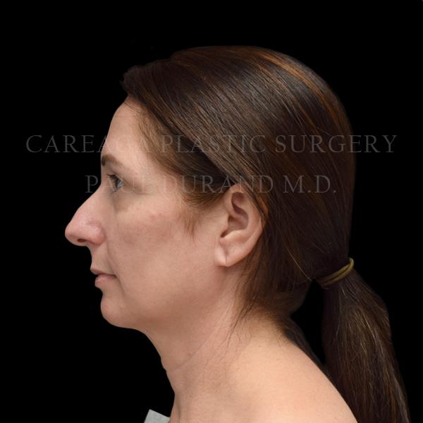 Rhinoplasty before at Careaga Plastic Surgery in Coral Gables, FL