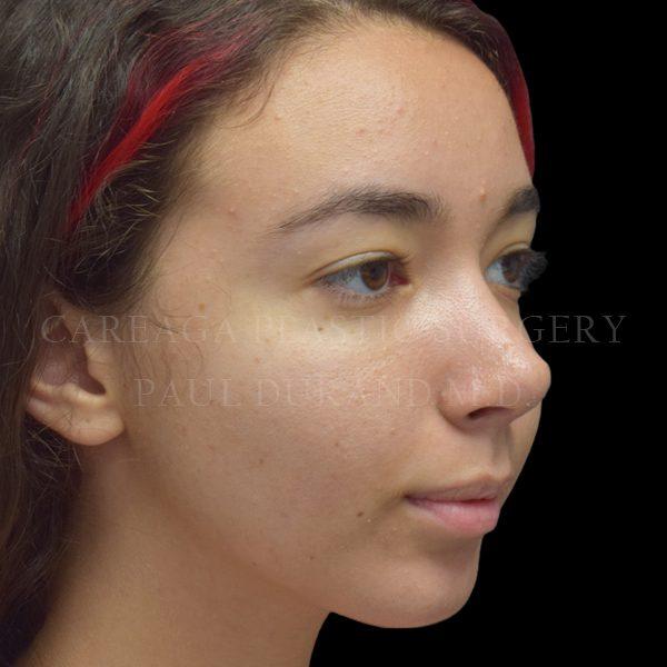Rhinoplasty after at Careaga Plastic Surgery in Coral Gables, FL
