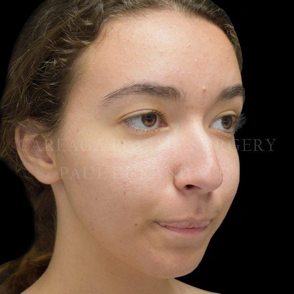 Rhinoplasty before at Careaga Plastic Surgery in Coral Gables, FL
