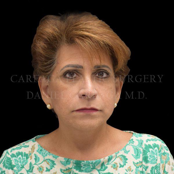 Careaga Plastic Surgery facelift after — Miami, FL
