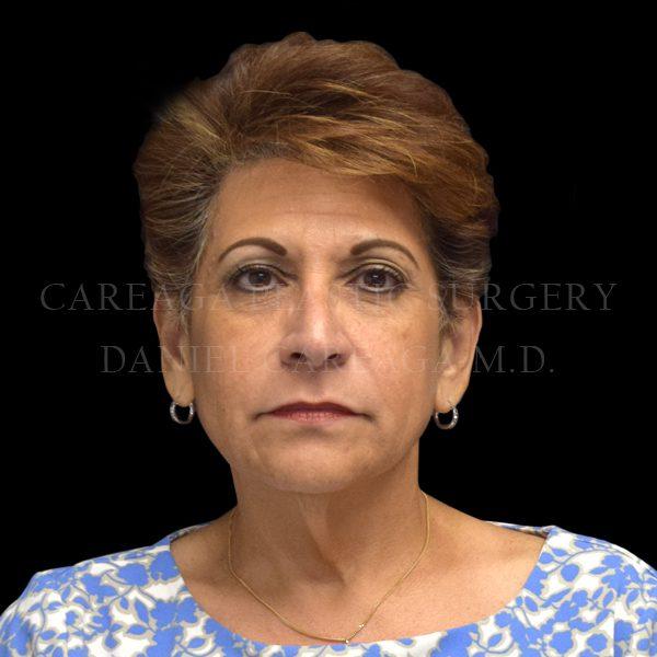 Mini Facelift before at Careaga Plastic Surgery in Coral Gables, FL