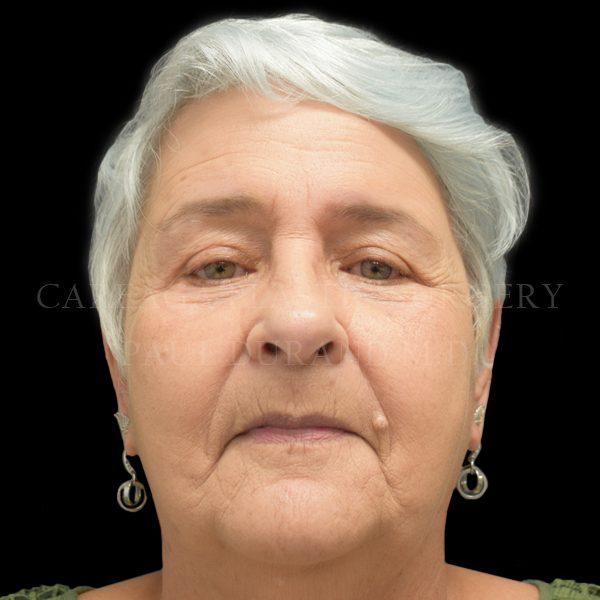 Blepharoplasty after at Careaga Plastic Surgery in Miami, FL
