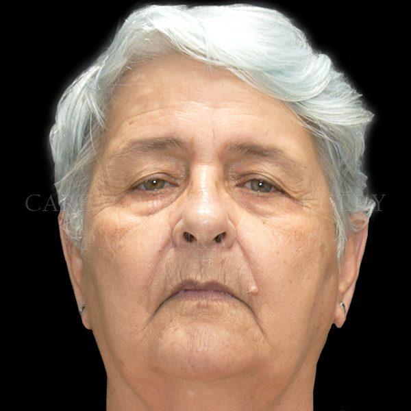 Blepharoplasty before at Careaga Plastic Surgery in Miami, FL